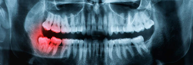 Affordable Wisdom Teeth Removal with Our Bellevue Dentist