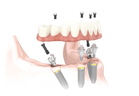 All-on-4® Treatment Concept | Overlake Dental Bellevue