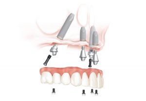 All-on-4® Treatment Concept | Overlake Dental Bellevue